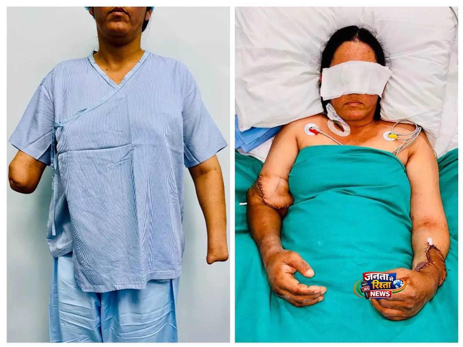 भूसा काटने वाली मशीन के हादसे में अपने दोनों हाथ गंवाने वाली एक युवा माँ को हैंड ट्रांसप्लांट से नई ज़िंदगी मिली भूसा काटने वाली मशीन के हादसे में अपने दोनों हाथ गंवाने वाली एक युवा माँ को हैंड ट्रांसप्लांट से नई ज़िंदगी मिली