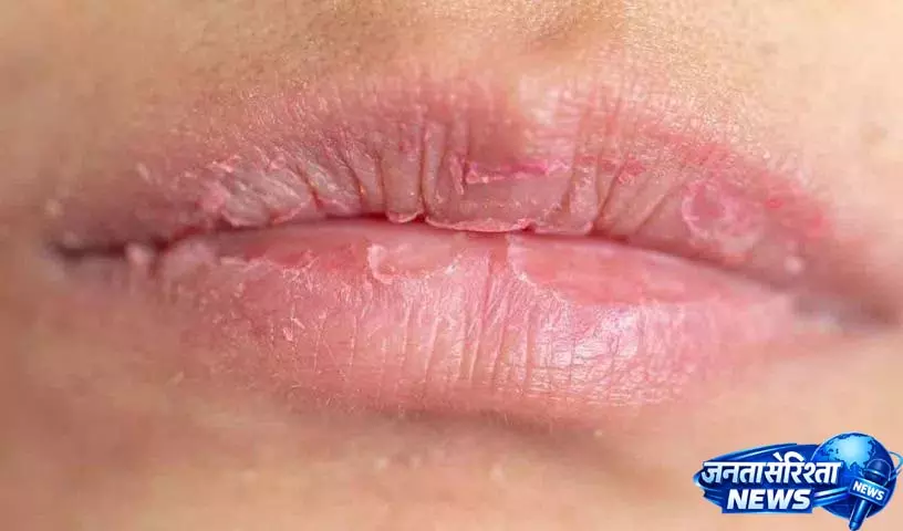 अगर आपको अक्सर Dry Lips की समस्या होती है तो ये उपाय अपनाएं अगर आपको अक्सर Dry Lips की समस्या होती है तो ये उपाय अपनाएं