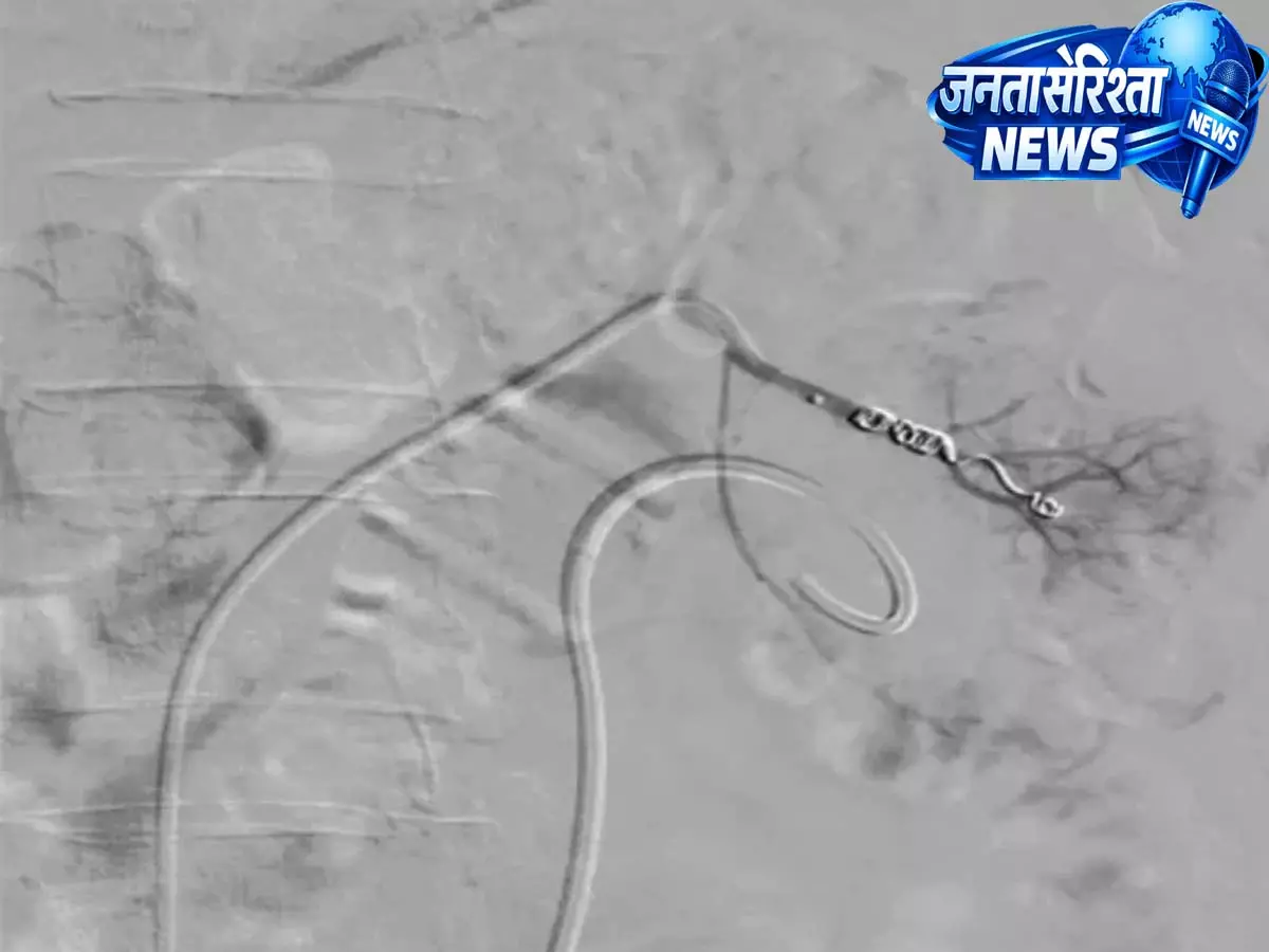 NAHARLAGUN: TRIHMS ने पहली बार रीनल आर्टरी स्यूडोएन्यूरिस का RI उपचार किया NAHARLAGUN: TRIHMS ने पहली बार रीनल आर्टरी स्यूडोएन्यूरिस का RI उपचार किया