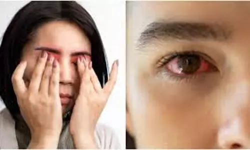 आंखों में जलन, भारीपन, खुजली? ये हो सकता है Dry Eye Syndrome, जानें बचाव के उपाय आंखों में जलन, भारीपन, खुजली? ये हो सकता है Dry Eye Syndrome, जानें बचाव के उपाय