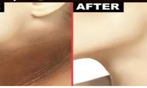 4 चीजों का कमाल, मसूर दाल से हटेगा गर्दन का कालापन 4 चीजों का कमाल, मसूर दाल से हटेगा गर्दन का कालापन