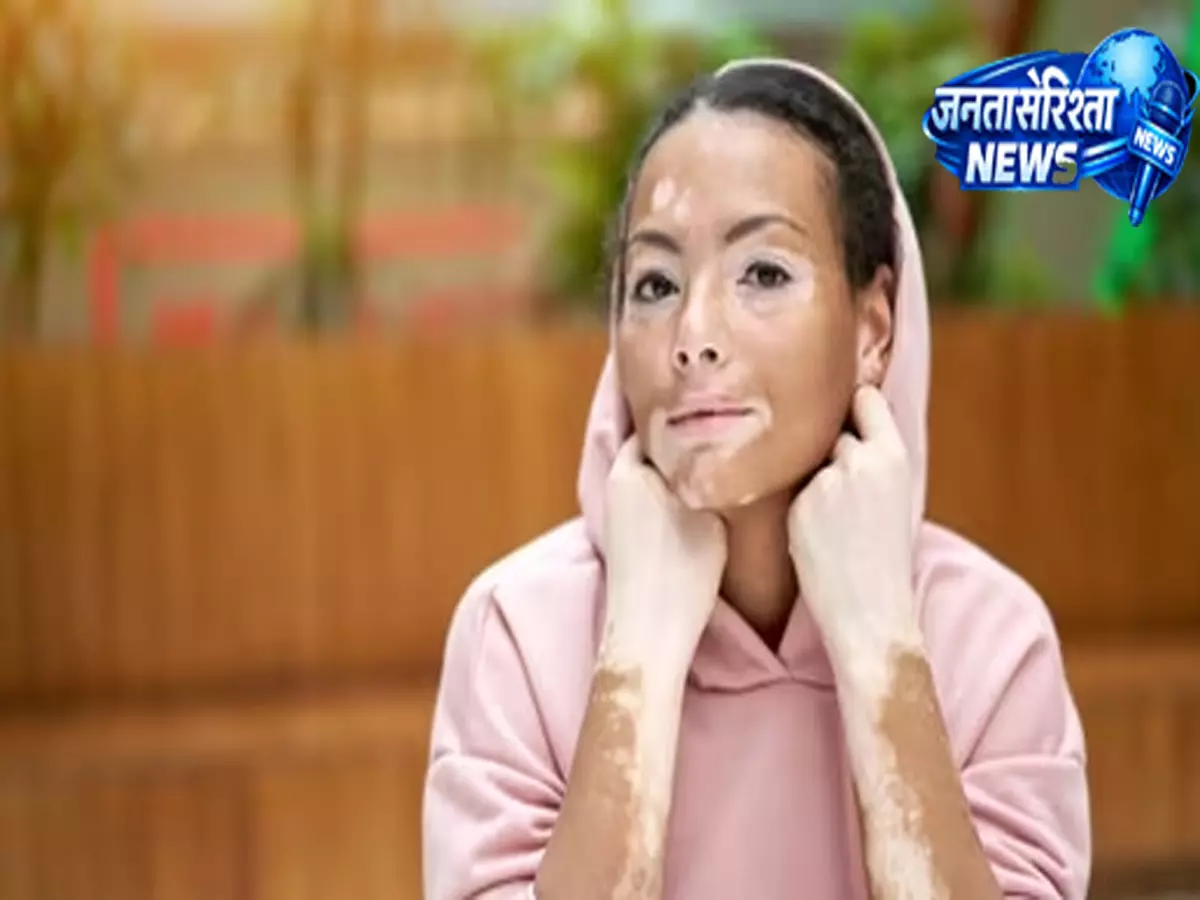 विटिलिगो को लेकर गलतफहमी दूर विटिलिगो को लेकर गलतफहमी दूर