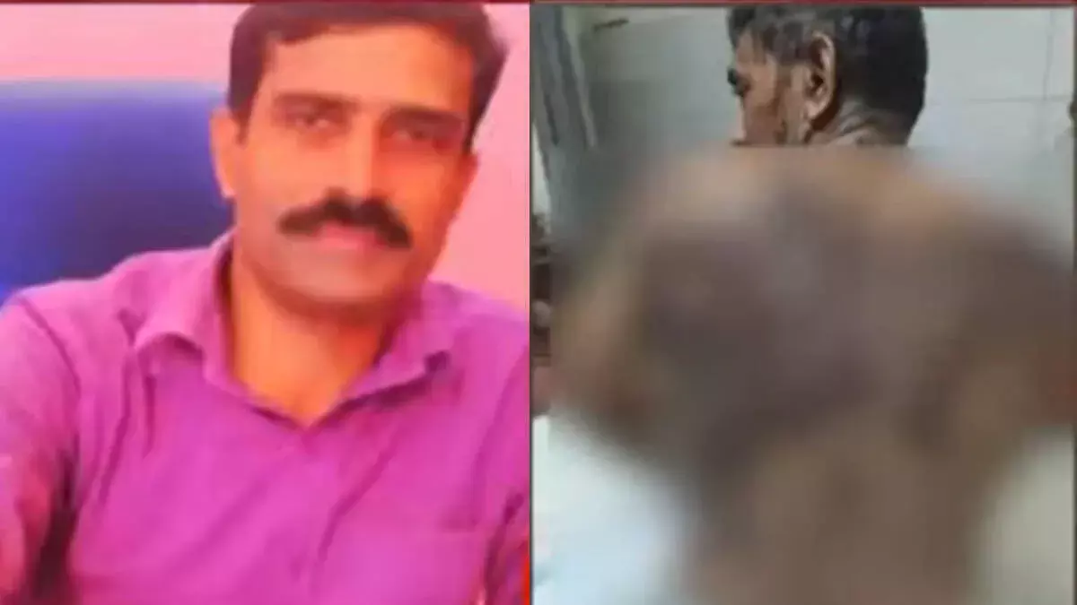 पलक्कड़ में पड़ोसी ने किया एसिड अटैक; युवक गंभीर रूप से घायल