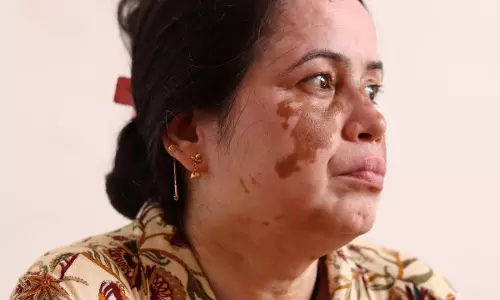 सफेद दाग से जुड़ा मिथ और असली तथ्य