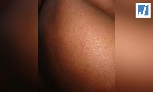 बांग्लादेश में खसरे का कहर जारी: 4 बच्चों ने तोड़ा दम, मृतकों की संख्या हुई 712 बांग्लादेश में खसरे का कहर जारी: 4 बच्चों ने तोड़ा दम, मृतकों की संख्या हुई 712