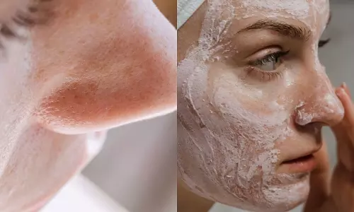 10 रुपये में पाएं Smooth skin ओपन पोर्स के लिए असरदार फेस पैक
