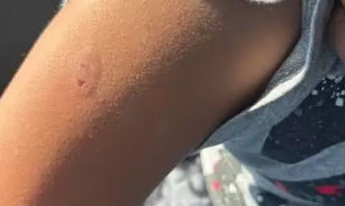 दांत से सहपाठियों को काटने लगा स्टूडेंट, धमतरी की घटना दांत से सहपाठियों को काटने लगा स्टूडेंट, धमतरी की घटना