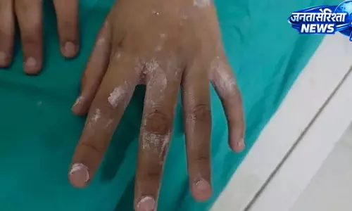 कस्तूरबा विद्यालय में छात्रा के हाथ पर गर्म सब्जी डालने का आरोप, जांच के आदेश