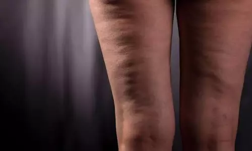 Cellulite Reduction Tips: सेल्युलाइट कम करने से पहले जानें 5 बड़े मिथ और सच्चाई Cellulite Reduction Tips: सेल्युलाइट कम करने से पहले जानें 5 बड़े मिथ और सच्चाई