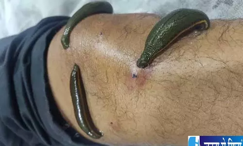 जोंक से इलाज कितना असरदार जानें लीच थेरेपी के फायदे और सावधानियां जोंक से इलाज कितना असरदार जानें लीच थेरेपी के फायदे और सावधानियां
