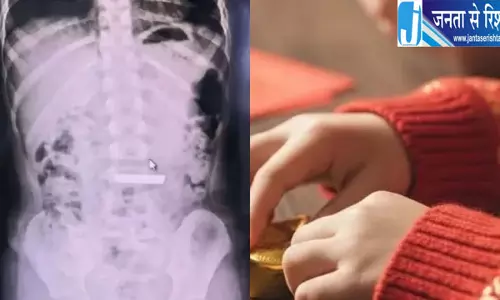 चीन में खेलते-खेलते बच्ची ने निगला 50 ग्राम सोने का बिस्किट, जटिल एंडोस्कोपी से निकाला गया