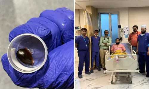 सांस की नली में फंसा चीकू का बीज