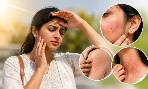 टैनिंग नहीं धूप से एलर्जी हो सकती है ये लक्षण पहचानें