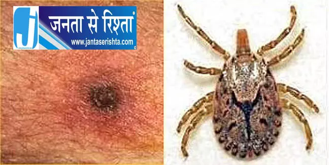 Bhubaneswar ELISA टेस्ट में स्क्रब टाइफस के सभी मामले खारिज Bhubaneswar ELISA टेस्ट में स्क्रब टाइफस के सभी मामले खारिज