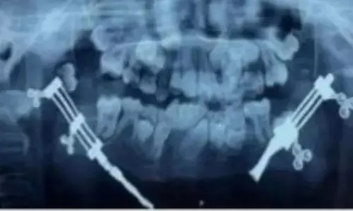 शिमला में बच्चे के छोटे जबड़े की सफल सर्जरी