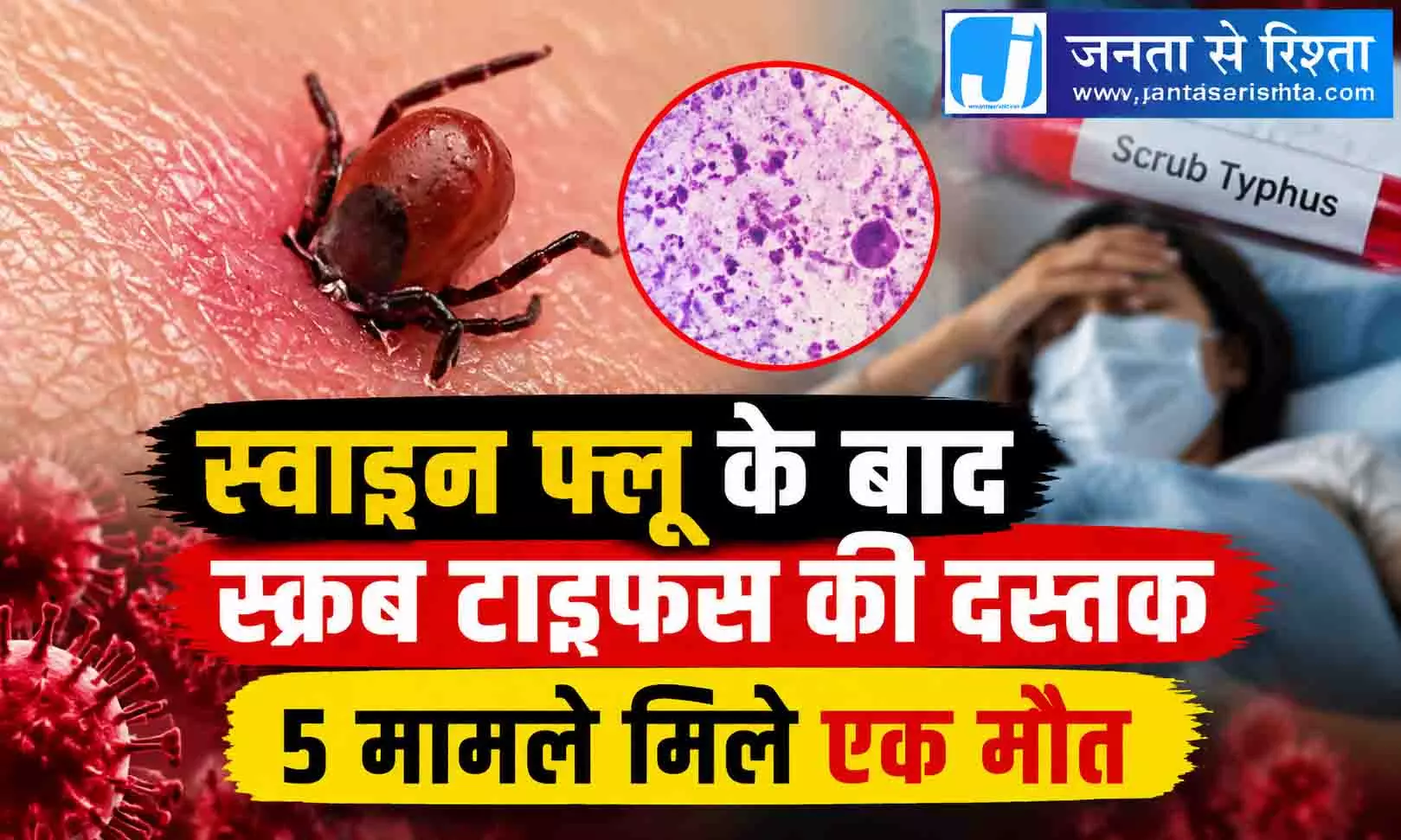 स्वाइन फ्लू के बाद स्क्रब टाइफस की दस्तक, 5 मामले मिले एक मौत स्वाइन फ्लू के बाद स्क्रब टाइफस की दस्तक, 5 मामले मिले एक मौत
