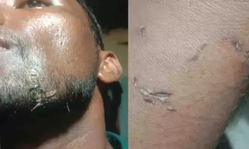 पागल कुत्ते का आतंक, सरपंच समेत कई लोगों को काटा पागल कुत्ते का आतंक, सरपंच समेत कई लोगों को काटा