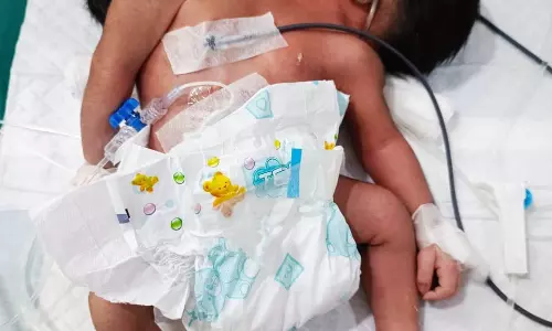 MKCG अस्पताल में दुर्लभ जन्म, आपस में जुड़े दो नवजात लड़के