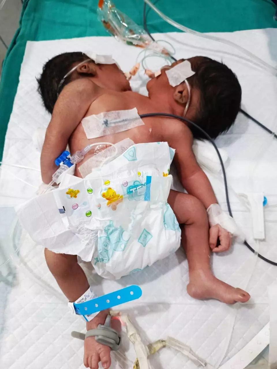 MKCG अस्पताल में दुर्लभ जन्म, आपस में जुड़े दो नवजात लड़के MKCG अस्पताल में दुर्लभ जन्म, आपस में जुड़े दो नवजात लड़के