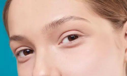 डार्क सर्कल कैसे हटाएं आंखों के नीचे काले घेरे कम करने के 7 उपाय